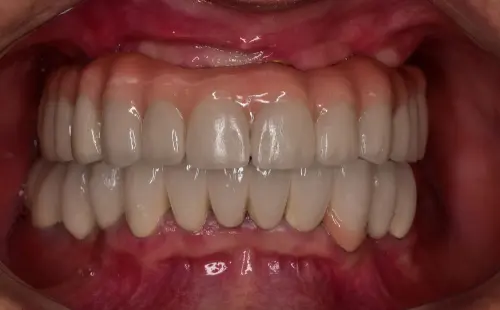 All-Teeth-Dental-Implants - Impressions Dental