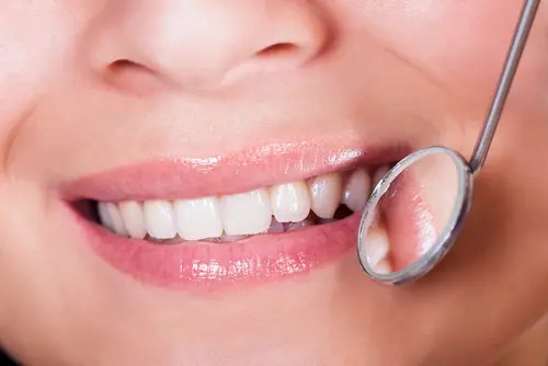 Benefits of Tooth-Colored Fillings - Impressions Dental