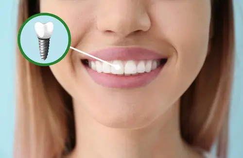 Benefits of a Single Tooth Dental Implant - Impressions Dental
