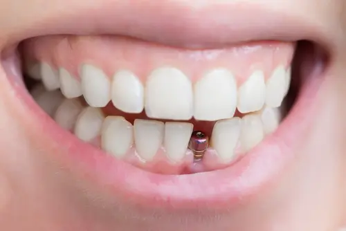 Better Than Dentures - Impressions Dental