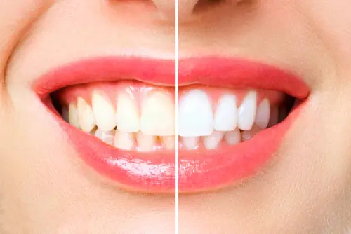 Chandler Tooth Whitening - Impressions Dental