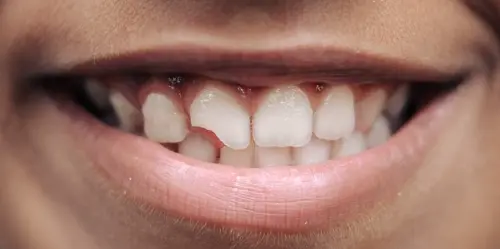 Chipped Tooth - Impressions Dental
