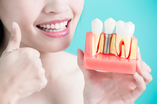 dental implants faq