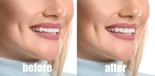 What is Gum Contouring and Reshaping - Impressions Dental