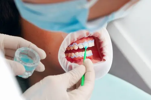 How Venus Teeth Whitening Works - Impressions Dental