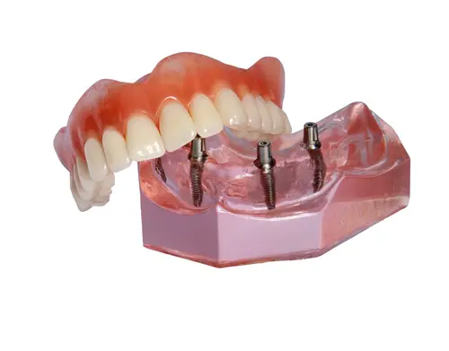 Implant-Dentures - Impressions Dental