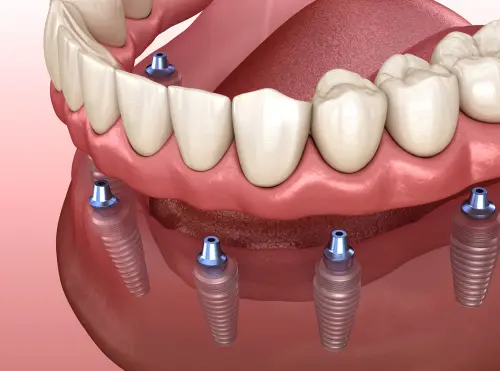 Implant Supported Dentures - Impressions Dental