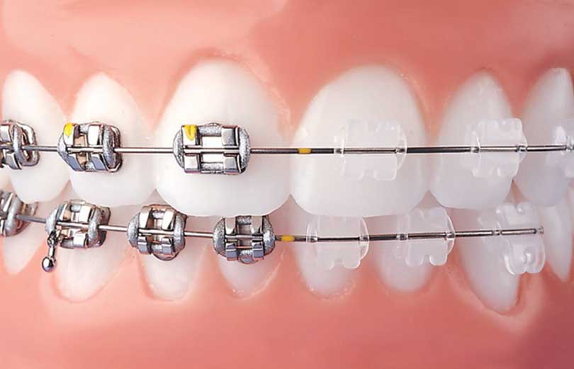 Ask a Dentist: Can ClearCorrect Invisible Braces Treat All Bite