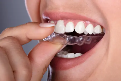 Is Invisalign or ImpressAlign Right for You - Impressions Dental