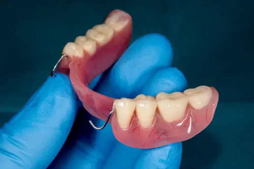 Partial Dentures for Back Teeth - Impressions Dental