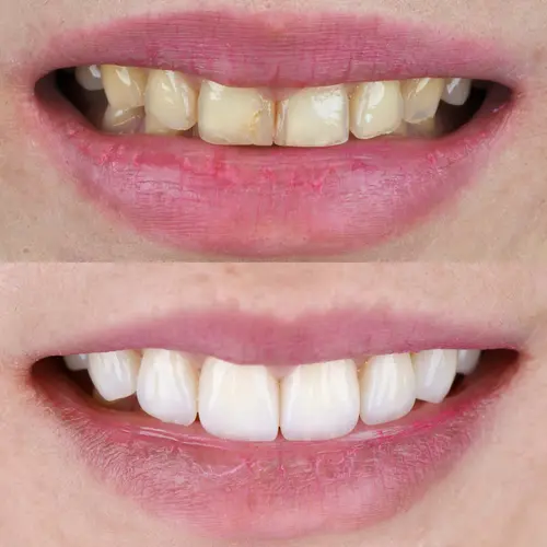 Problems Fixed by Dental Veneers - Impressions Dental