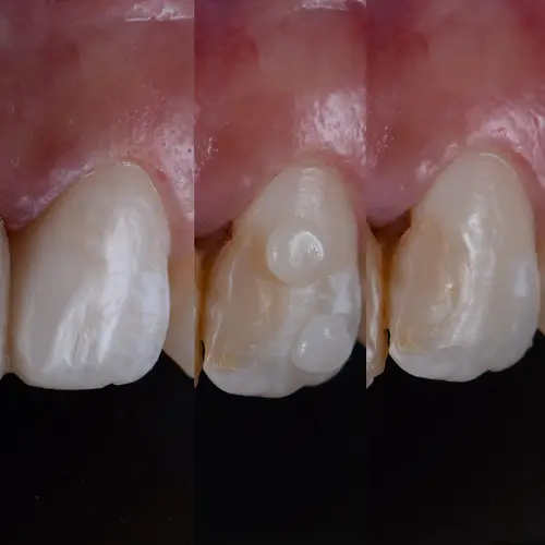 Problems Fixed by Tooth-Colored Fillings - Impressions Dental