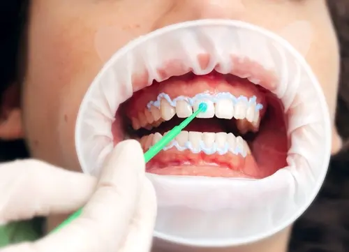 Professional Teeth Whitening and How it Works - Impressions Dental