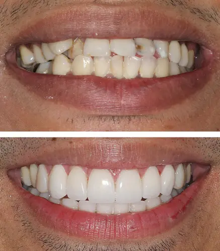 Problems Corrected by a Snap-On Smile - Impressions Dental