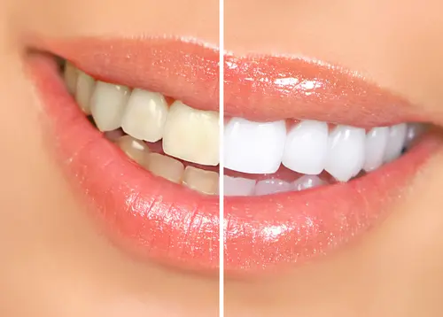 Same Day Dentistry and Teeth Whitening - Get a Great Smile at Impressions Dental