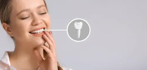 Single-Tooth-Dental-Implant - Impressions Dental