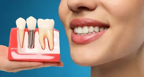 Single Tooth Implant Procedure - Impressions Dental