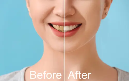 Typical Smile Makeover Procedures - Impressions Dental