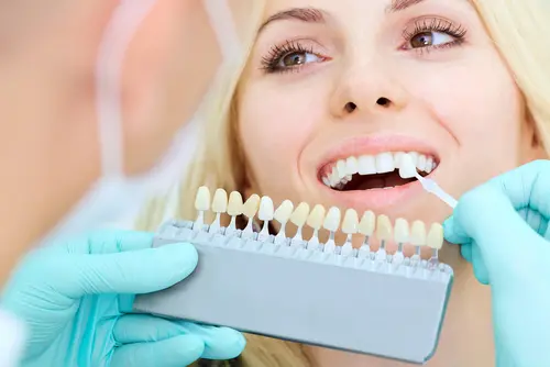 Venus is one of the Best Teeth Whitening Treatments - Impressions Dental