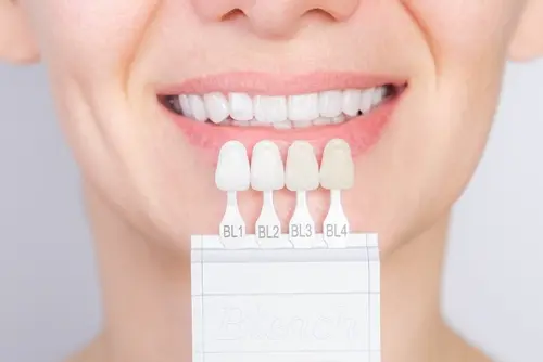 What Are Porcelain Veneers - Impressions Dental