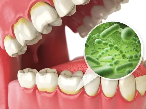 What Causes Gum Disease - Impressions Dental
