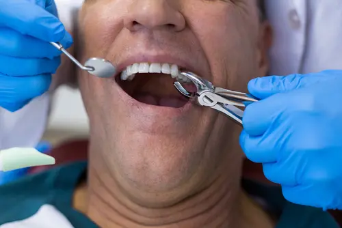 What an Extraction Procedure is Like - Impression Dental
