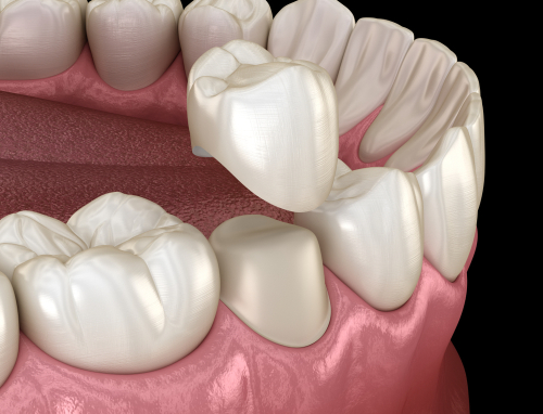 can a cracked tooth be saved with a root canal and crown