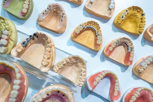 dental implant durability