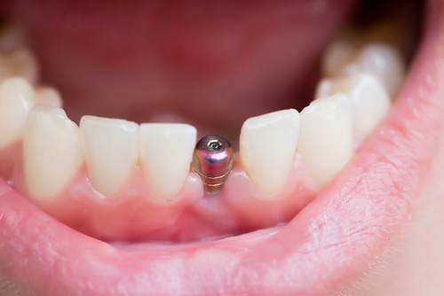 dental implants 101