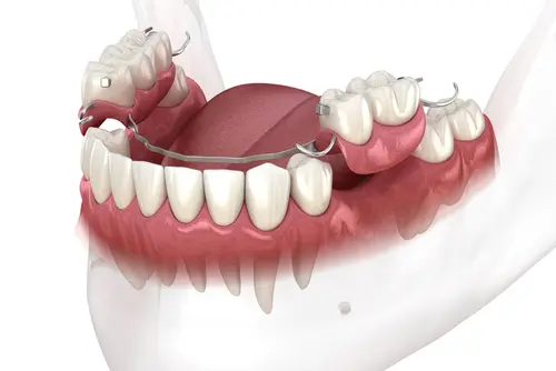 Dental Bridges - Impressions Dental