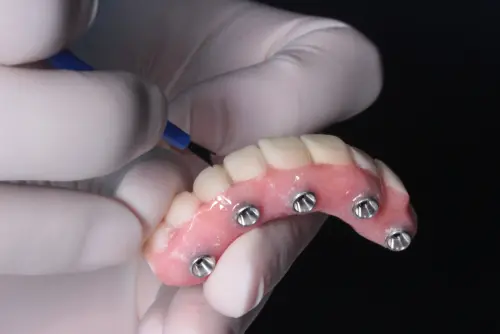 Dentures with Secure Implants - Impressions Dental
