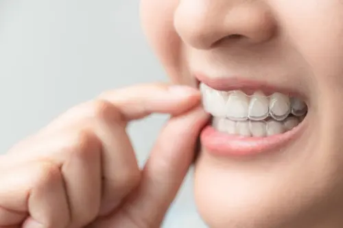 Enjoy Major Benefits from Invisalign for Adults - Impressions Dental