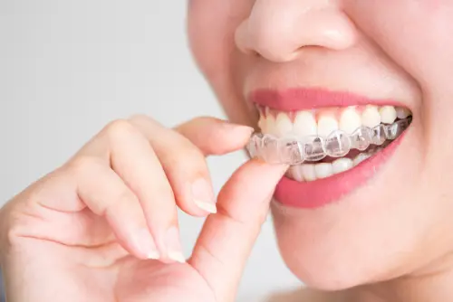 Invisalign 101 - Everything You Need to Know at Impressions Dental