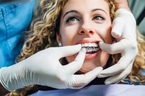Invisalign Checkups - Impressions Dental
