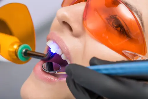 Lumineers as Restorations - Impressions Dental