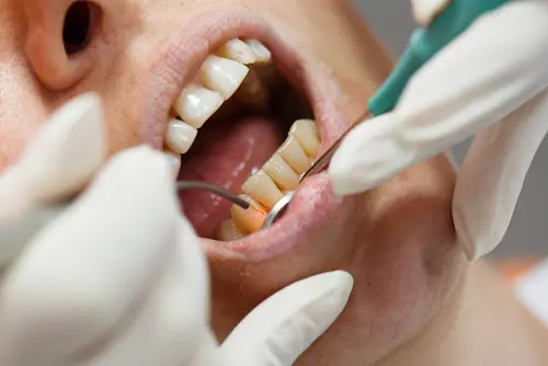 Laser Gum Surgery- Impressions Dental
