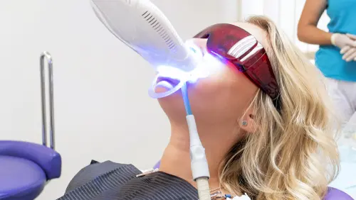 Laser Teeth Whitening - Impressions Dental