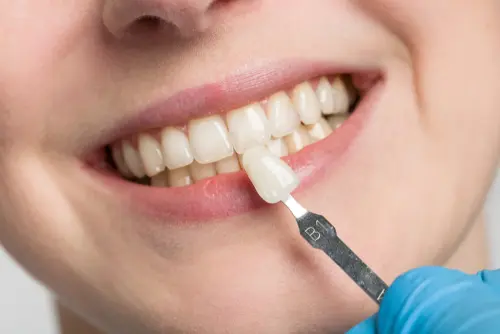 Lumineers are Reversible - Impressions Dental
