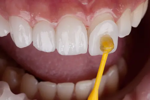 Lumineers vs DentalVeneers - Impressions Dental