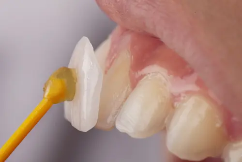 Process of Receiving Lumineers - Impressions Dental