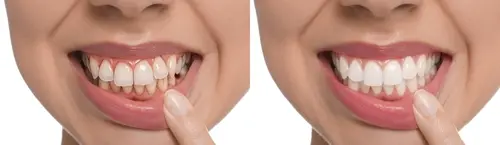how dental implants work 