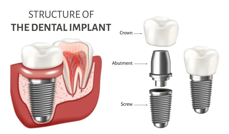 how dental implants work 