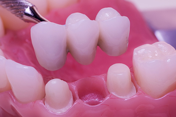 dental bridge or dental implant