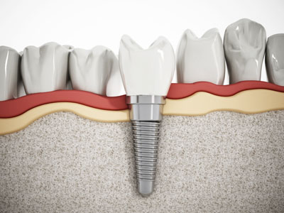 Signs that It's Time to Replace Teeth Mini Implants