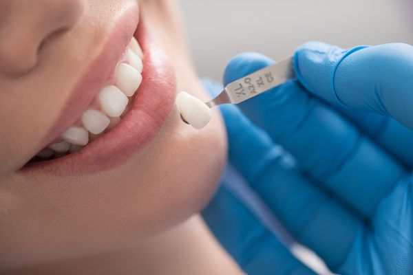 Are Dental Veneers the Right Fix for Your Teeth?