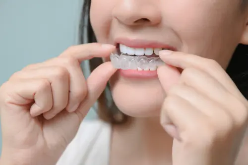 How Invisalign Works - Impressions Dental Shows You How