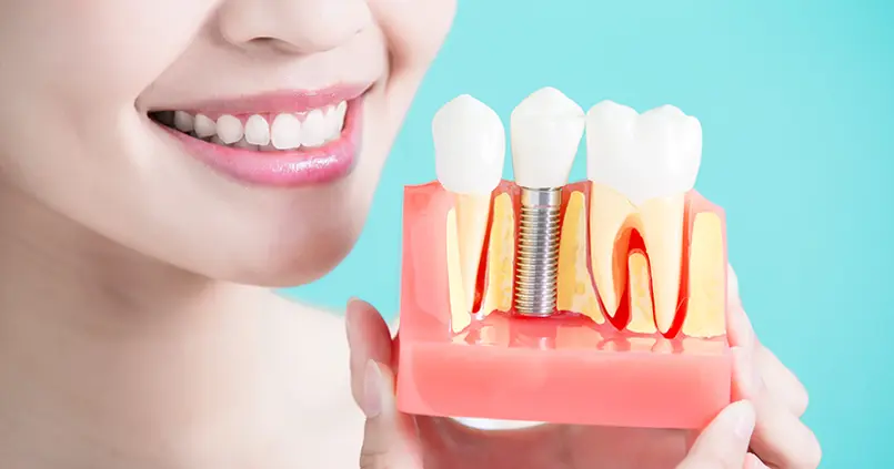 See dental implants facts and stats at impressions dental